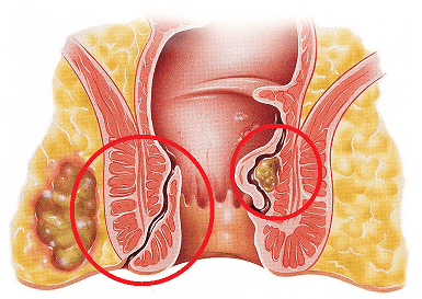 Anal Fistül