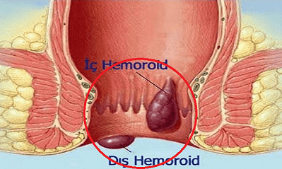 Hemoroid